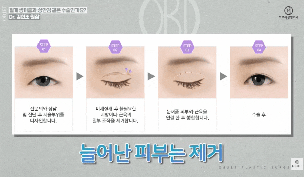 Middle-Aged Double-Eyelid Surgery vs. Upper Blepharoplasty: What’s the Difference? <Differences> Summarized! image 4