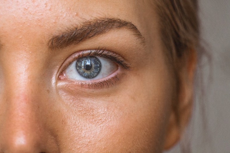 My Eyes Look Far Apart: Why We Do Epicanthoplasty image 1