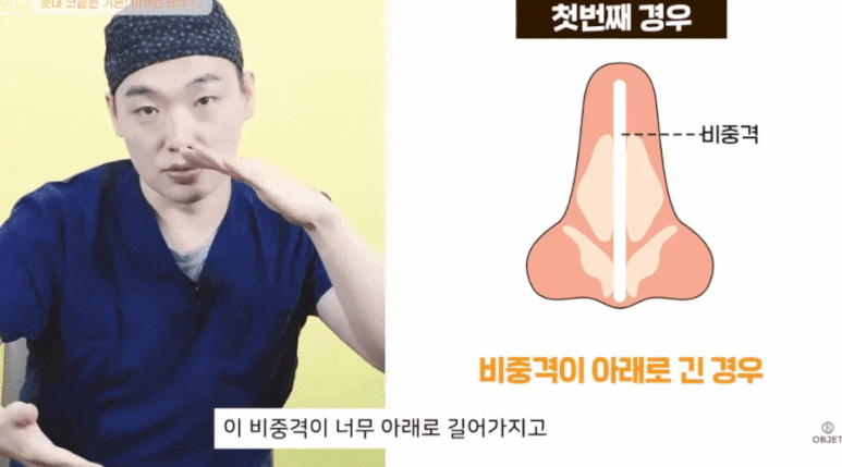 Tip Rhinoplasty: Don’t Overlook the Columella! A Summary by Dr. Lee Kyung-mook image 5