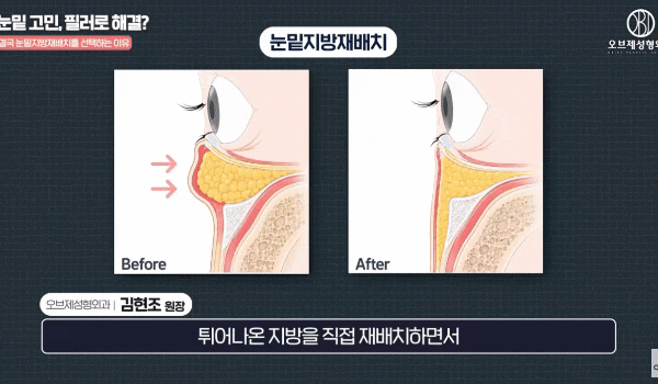 Why Does Satisfaction Differ Before and After Under-Eye Filler? image 8
