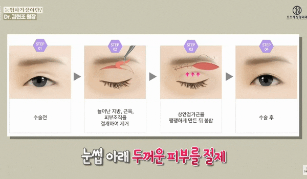 Drooping Eyelids and Sagging Upper Eyelids image 4