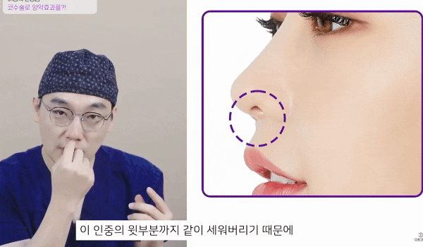 Alar-Retraction Rhinoplasty: Does It Make the Philtrum Look Longer? <Answer from Dr. 이경묵> image 3
