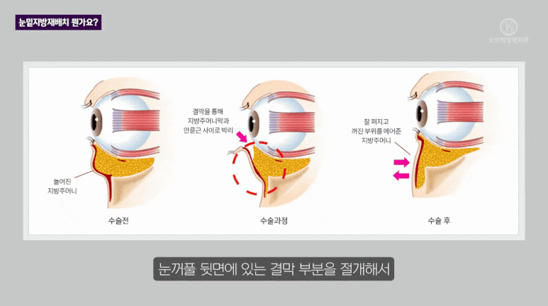 눈밑 지방재배치 수술, 가장 많이 들은 질문 TOP2는? 관련 이미지 5