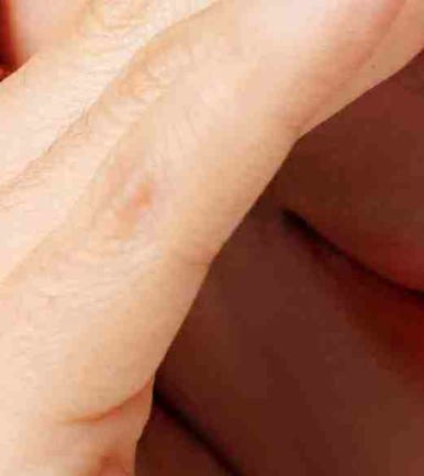 The Difference Between Upper Blepharoplasty and Incisional Double Eyelid Surgery #Director Kim Hyun-jo image 15