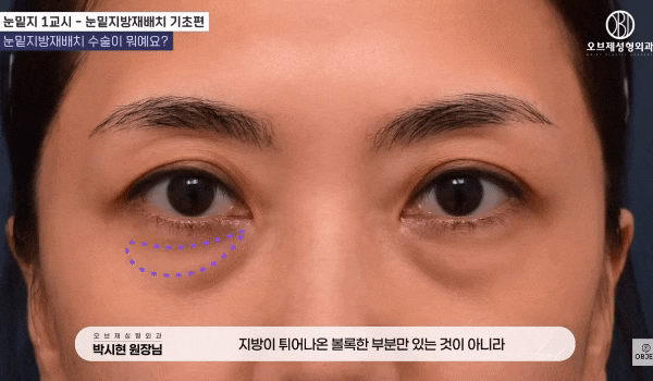 Why Is Revision Surgery Needed After Under-Eye Fat Repositioning? image 7