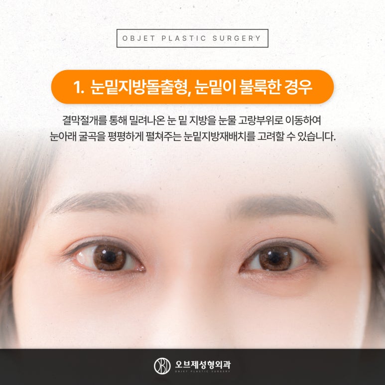 눈밑꺼짐과 불룩해지는 이유 관련 이미지 3