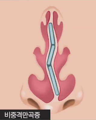 Nasal Surgery for Rhinitis: You Should Choose a Clinic That Knows ‘This’ Well! image 4