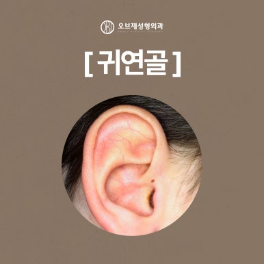 Natural Tip Rhinoplasty #Yeoksam-dong#Gangnam image 6