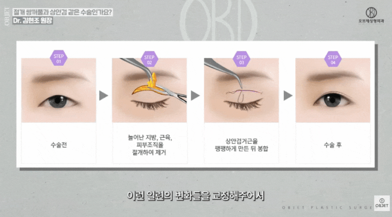 중년 눈수술? 쌍수? 김현조 원장님이 말하는 <차이점> 관련 이미지 4