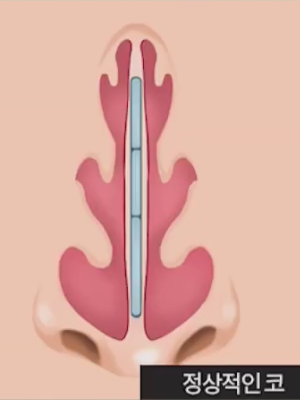 Nasal Surgery for Rhinitis: You Should Choose a Clinic That Knows ‘This’ Well! image 3