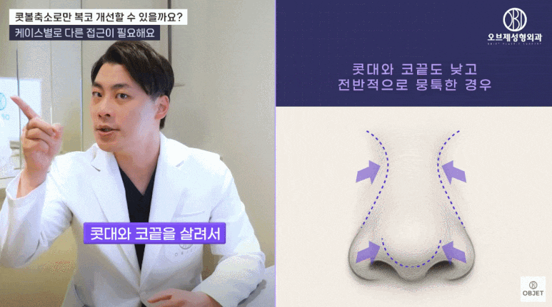 콧볼축소잘하는곳은 복코수술에서 콧볼만 보지 않습니다! (오브제성형외과 복코성형 TIP!) 관련 이미지 5