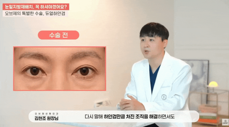 Precautions for Under-Eye Fat Repositioning? Director Kim Hyun-jo’s <How to Choose the Right Surgery> image 13