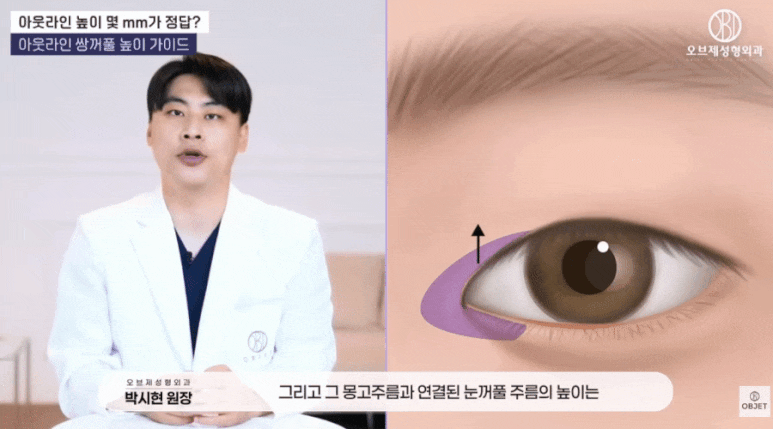 What Is the Pretty Height for an Out-Line Double Eyelid? Director Park Si-hyeon’s Answer! image 5