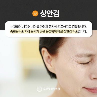 Fine Wrinkles Beside the Eyes, Brow Lift image 7