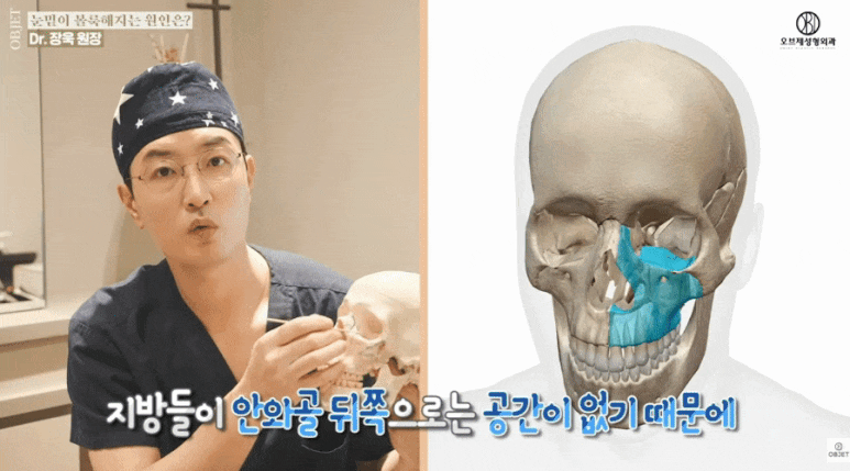 Cause of Under-Eye Fat? Read Dr. Jang Wook’s <Key Summary> First! image 4
