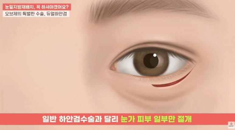 Precautions for Under-Eye Fat Repositioning? Director Kim Hyun-jo’s <How to Choose the Right Surgery> image 12