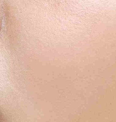 Brow Lift Procedure Method — Objet Plastic Surgery, Director Kim Hyun-jo image 17
