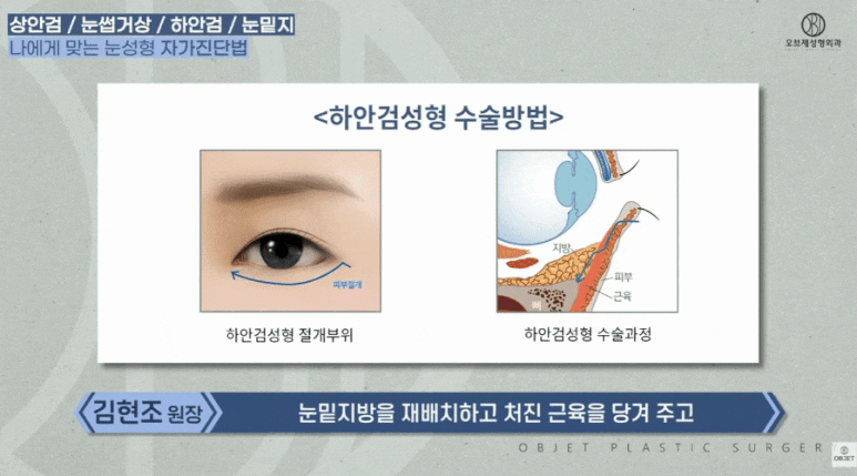 Worried About Choosing Midlife Eye Surgery? Director Kim Hyun-jo Will Set It Straight image 8