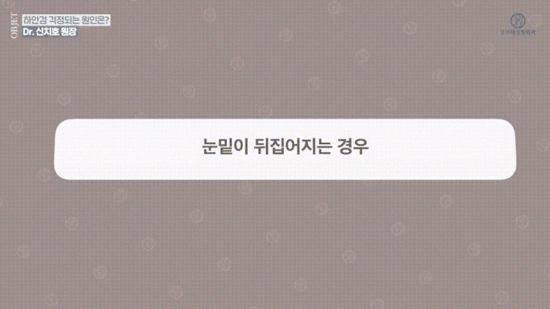 눈밑 뒤집힘, 애교살, 흉터 등 하안검수술 부작용 관련 이미지 3