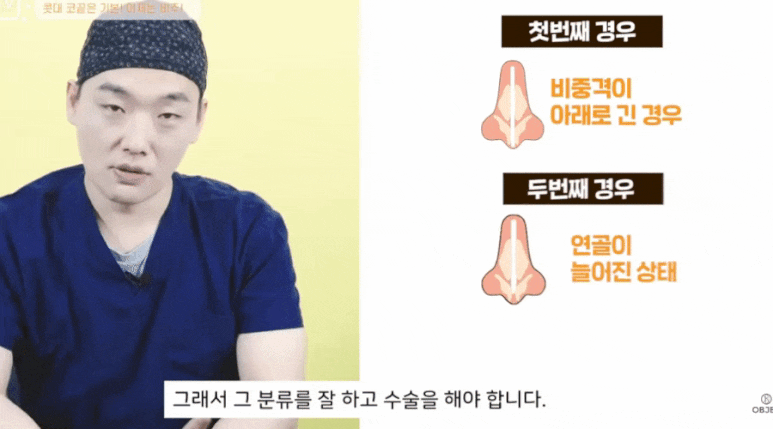 Tip Rhinoplasty: Don’t Overlook the Columella! A Summary by Dr. Lee Kyung-mook image 7