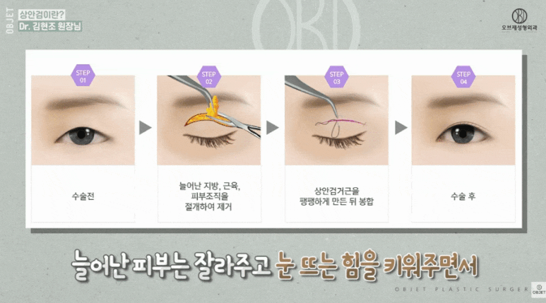 Three Eyelid Drooping Surgeries Explained by Director Kim Hyun-jo! image 4