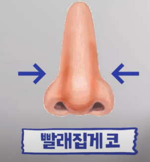 코성형 콧구멍 110V 빨래집게 코 #이경묵원장님 관련 이미지 3