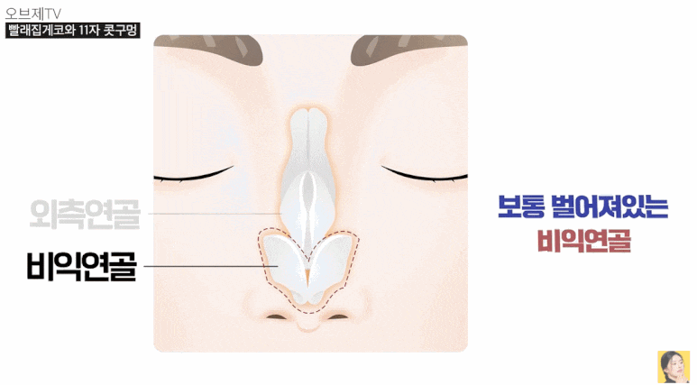 찝힌코 재수술? 빨래집게코, 11자코 해결 안 될까요? (성형외과 전문의 TIP) 관련 이미지 7