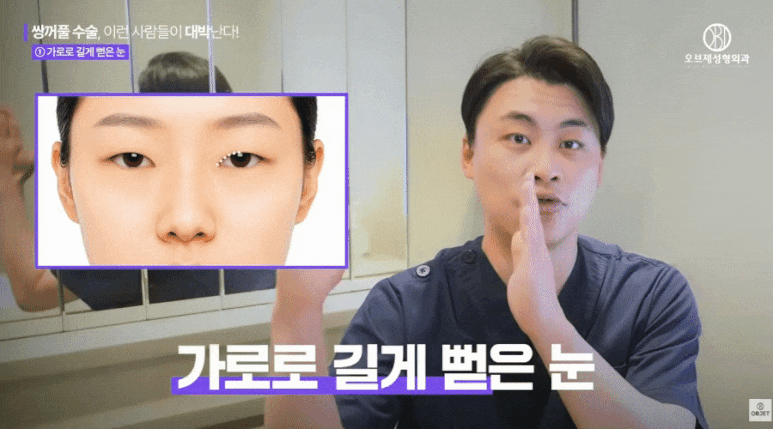 눈매교정수술전후? 박시현 원장님이 추천하는 졸린눈 수술! 관련 이미지 6