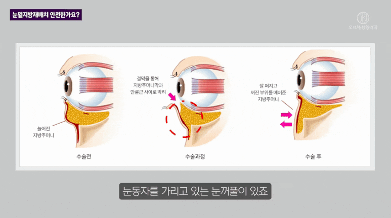 눈밑 지방재배치 수술, 가장 많이 들은 질문 TOP2는? 관련 이미지 8