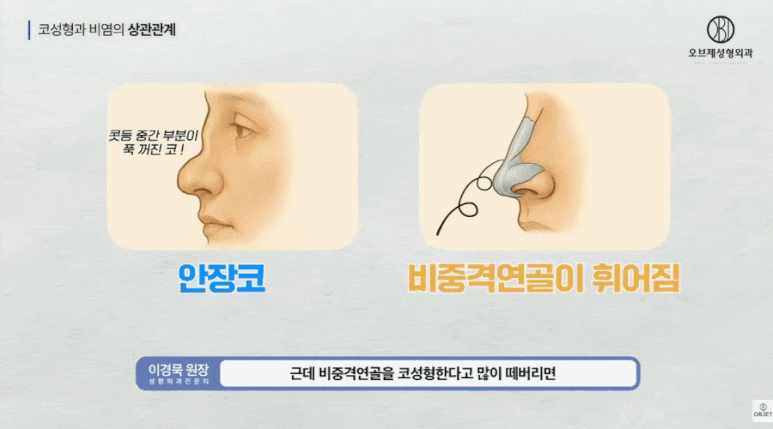 비염수술코성형 진짜 관계 있어요? 이경묵 원장님 답변! 관련 이미지 7