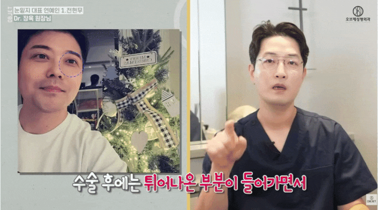 눈밑지방재배치 연예인 TOP 5! 장욱 원장님이 분석해 드립니다 관련 이미지 3