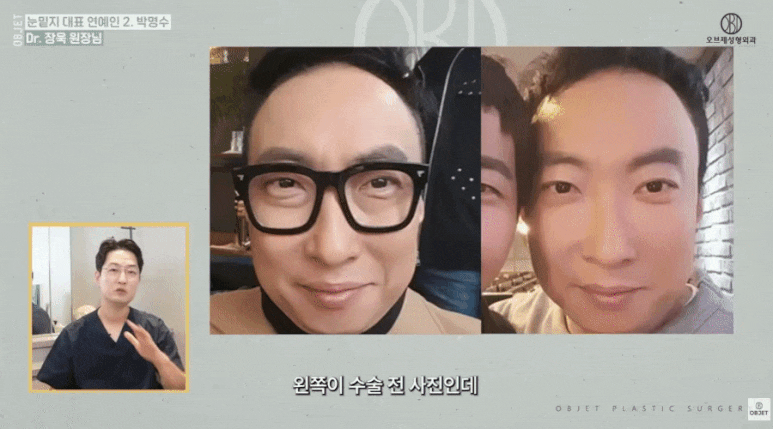 눈밑지방재배치 연예인 TOP 5! 장욱 원장님이 분석해 드립니다 관련 이미지 4