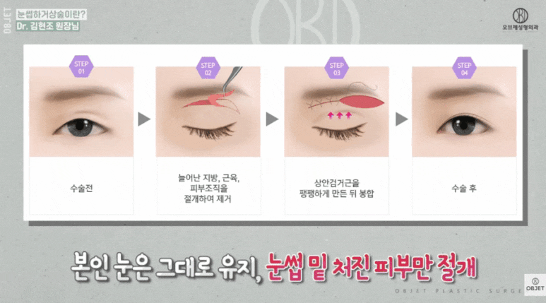 Forehead Lift Effect? For Drooping Eyelids, Director Kim Hyun-jo’s <3> Recommendations! image 5