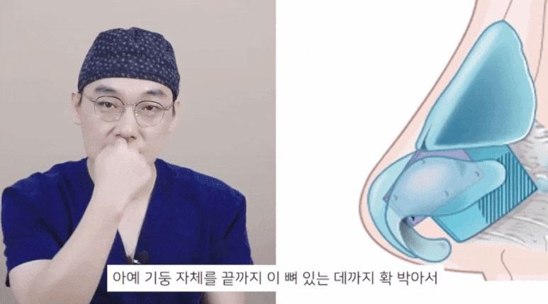 Can Correcting the Nasolabial Angle Fix a Protruding Mouth? The Truth Revealed by Director Lee Kyung-mook image 7