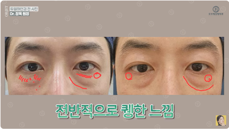 A Review of Dr. Jang Uk’s Dual Lower Blepharoplasty at Obje Plastic Surgery image 3