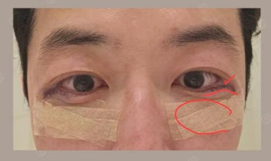 듀얼하안검 후기, 수술당일부터 69일까지 생생보고 #오브제성형외과 장욱원장님 관련 이미지 2