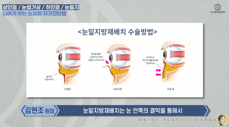 What Is the Difference Between Upper Eyelid and Lower Eyelid Surgery? Are There Different Procedures for Different Eyes? (Explanation by a Board-Certified Plastic Surgeon) image 15