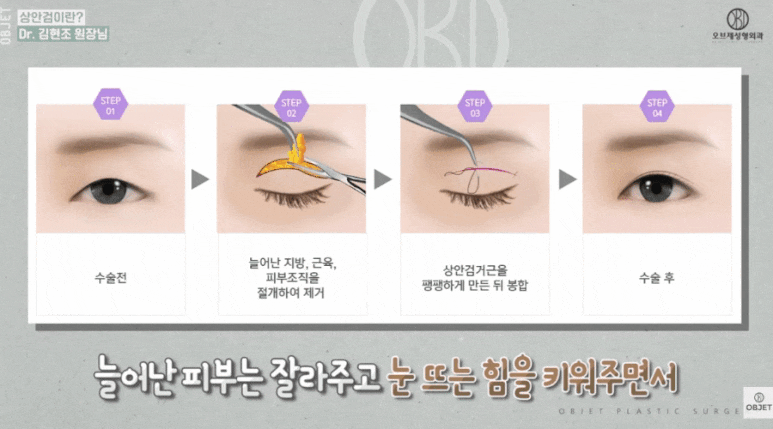 Forehead Lift Effect? For Drooping Eyelids, Director Kim Hyun-jo’s <3> Recommendations! image 3