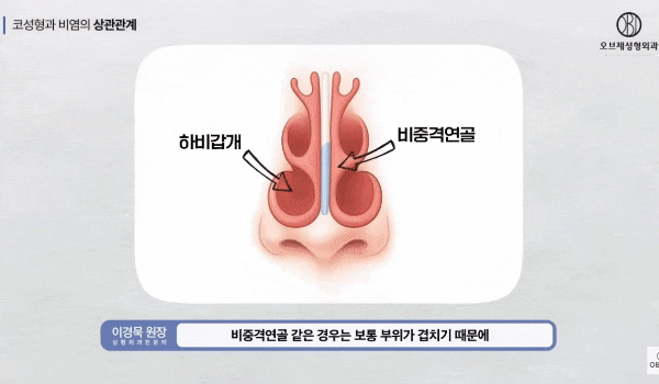 Recommended Clinic for Rhinitis Surgery: Can Functional Rhinoplasty Resolve Rhinitis? Revealing the Truth image 6