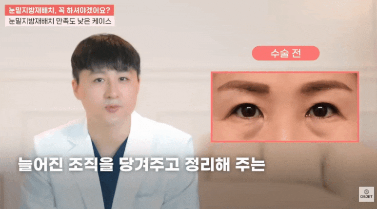 하안검 뜻? 김현조 원장님이 눈밑 고민 해결해 드립니다! 관련 이미지 6