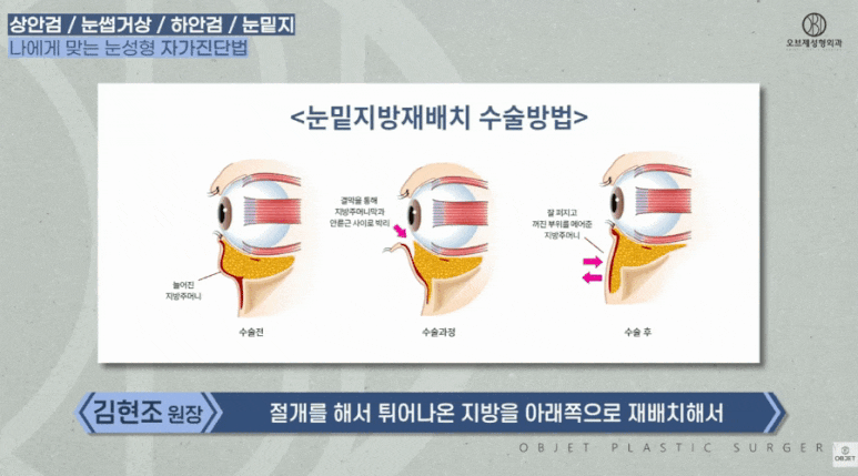 Worried About Choosing Midlife Eye Surgery? Director Kim Hyun-jo Will Set It Straight image 7