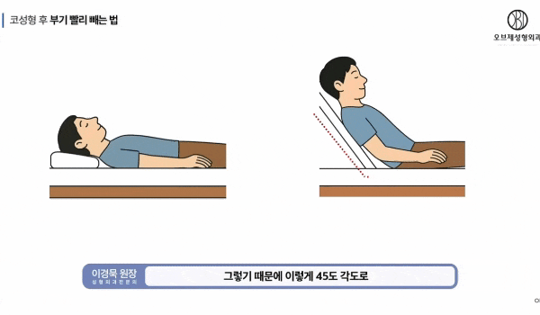Tips from Director Lee Kyung-mook for Reducing Rhinoplasty Swelling and Shortening the Recovery Period! image 7