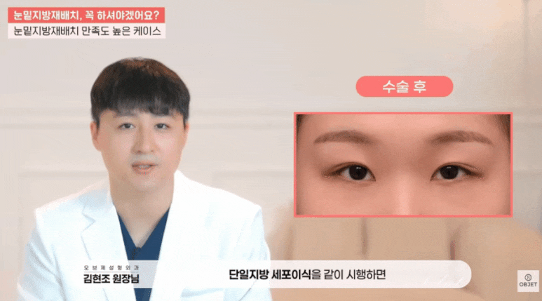 하안검 뜻? 김현조 원장님이 눈밑 고민 해결해 드립니다! 관련 이미지 4