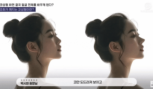 Why Don’t the Tips of the Nose Droop at Well-Known Rhinoplasty Clinics? The Secret Revealed! image 6