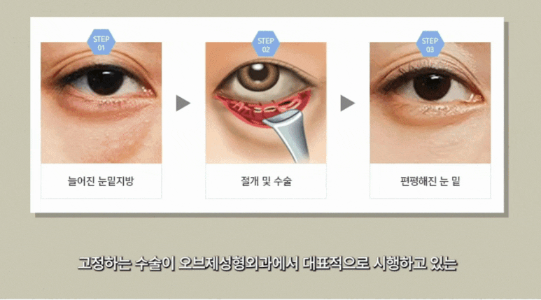 Cause of Under-Eye Fat? Read Dr. Jang Wook’s <Key Summary> First! image 8