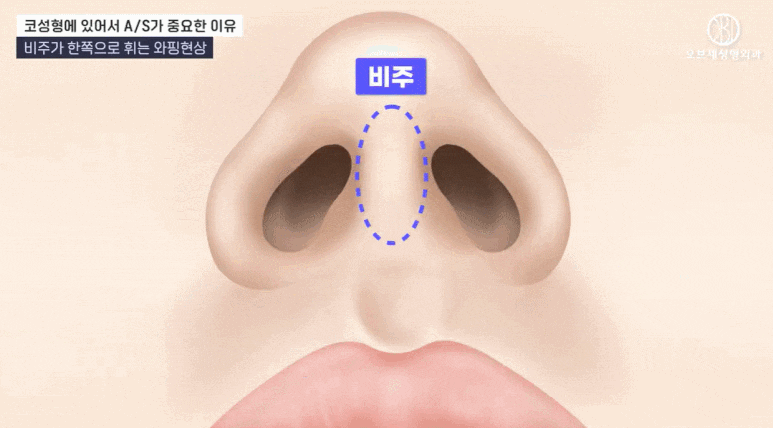 코성형 부작용 증상이 의심된다면? &lsquo;이것&rsquo;부터 병원에 확인해 보세요 관련 이미지 6