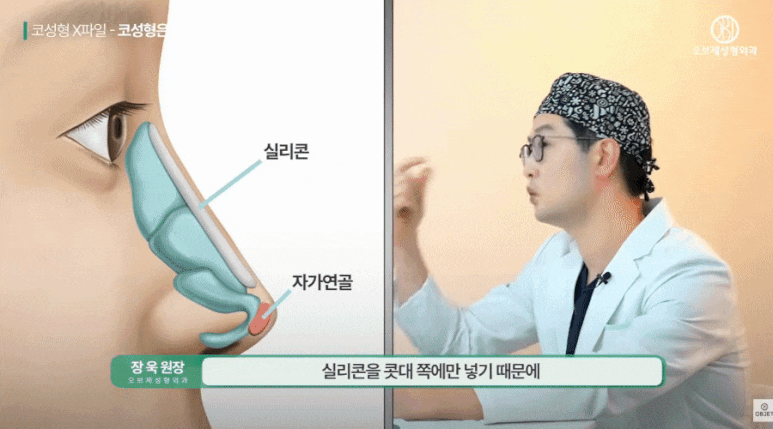 The Most Common Question Asked at a Revision Rhinoplasty Clinic! - Dr. Jang Wook’s Answer image 5