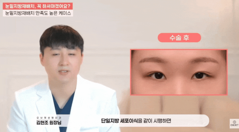 다크써클 수술 눈밑지로 된다면서요? 김현조 원장님 답변! 관련 이미지 8