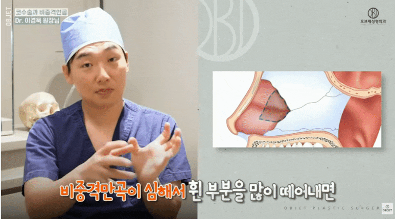 Is Drooping at the Nasal Tip Caused by the Material? The Real Reason Dr. Lee Kyung-muk Talks About image 4