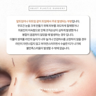 Where to Get Good Revision Eye Surgery: 고민 After a First Failure image 4